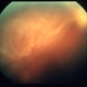 vitreous haze and retinal detachment